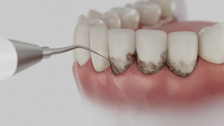 Trusted Wisdom Tooth Removal service in Eaton Estates, OH - Dentist Open Now